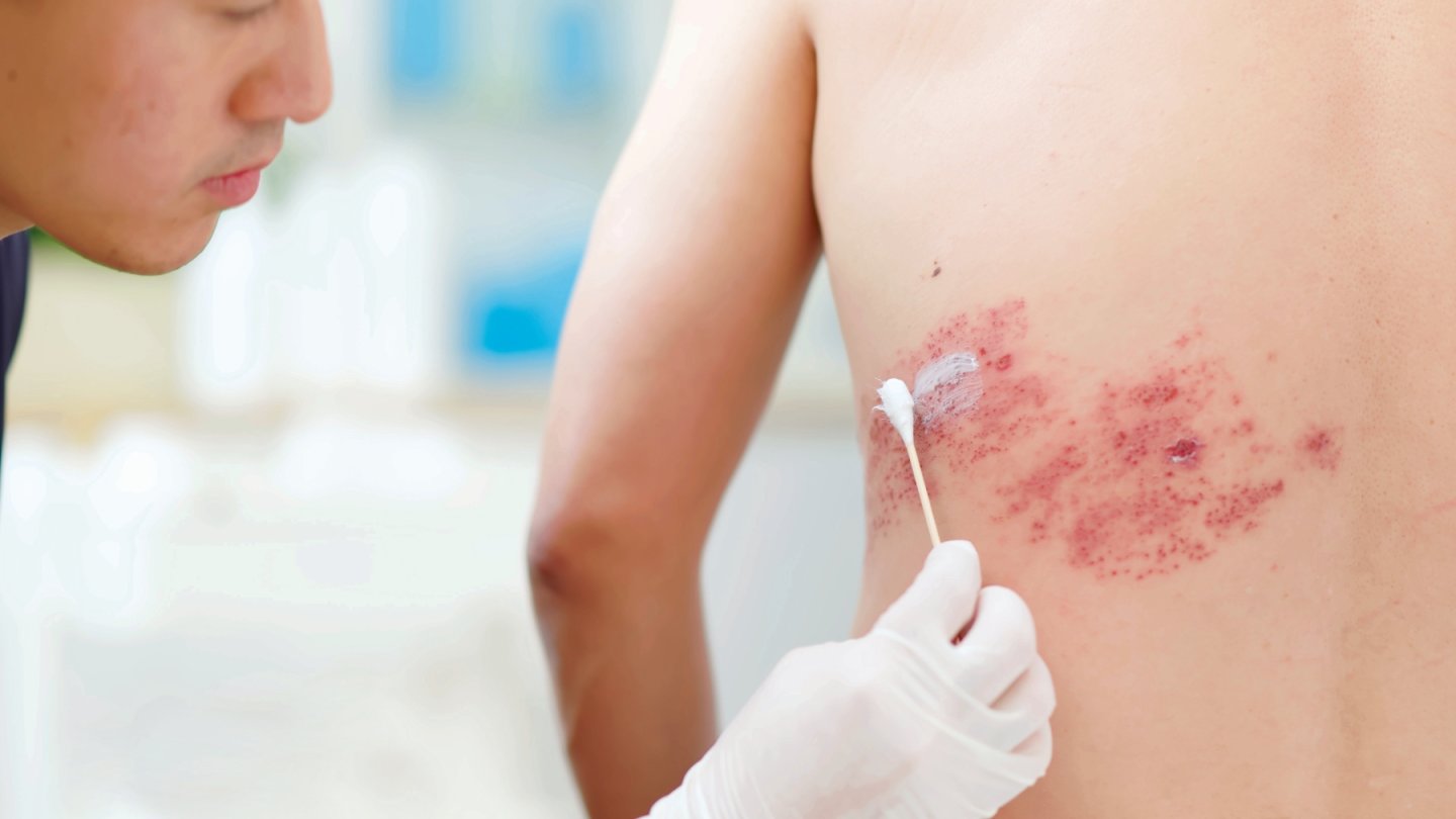 zona maladie dermatologie peau irruption cutanée vaccin